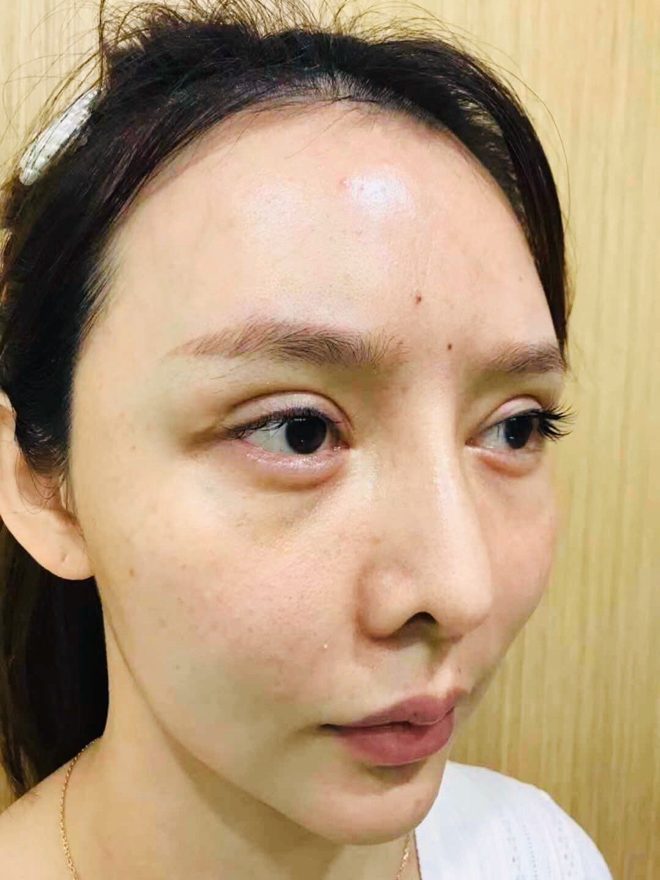 双眼皮修复术前,明天预约了睐美安王振军