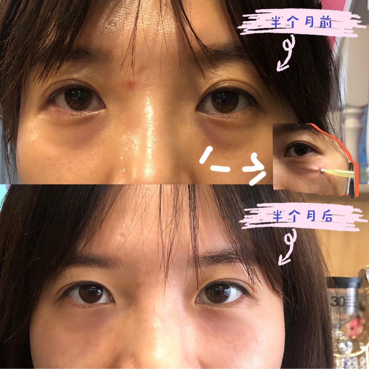 自己做完眼部线雕后效果非常好,之前黑眼圈严重有一些_圈子-新氧美容