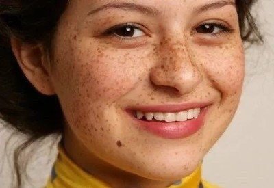 what雀斑是遗传的?那你怎么破?