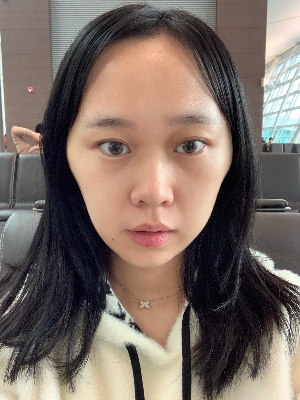 线雕第四天 太阳穴下面肿的巨大 还不消肿 求救 第_圈子-新氧美容整形