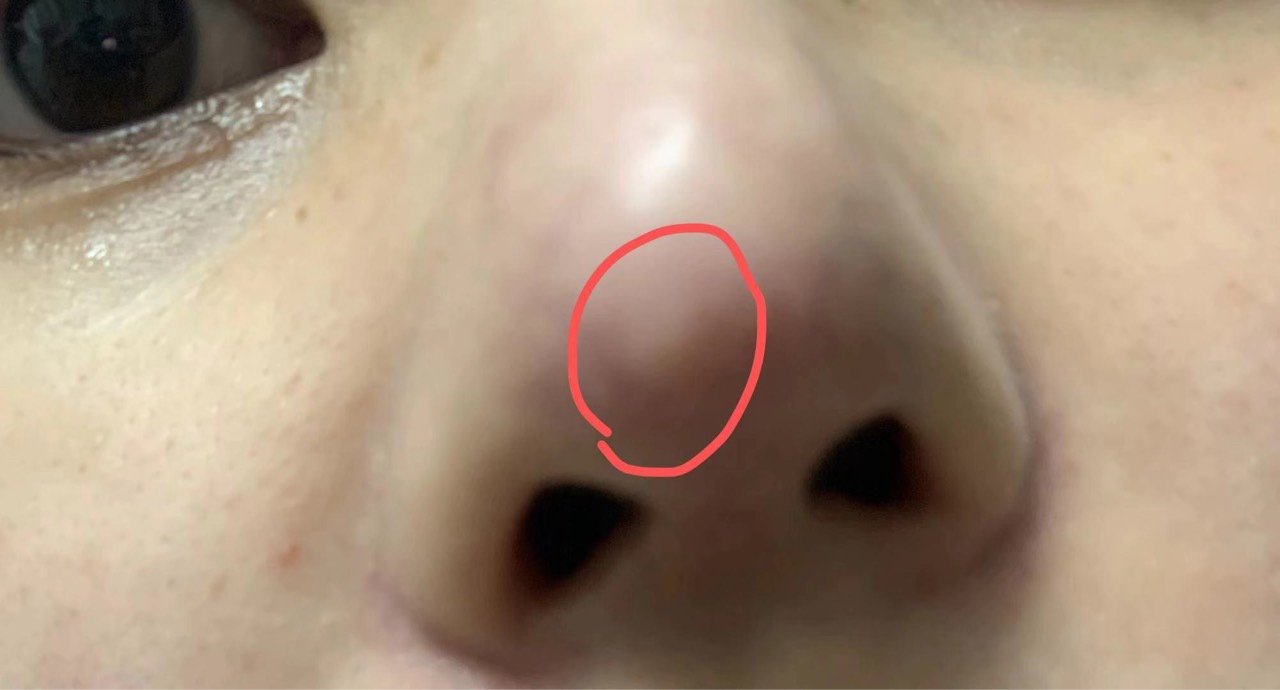 急! 硅胶 肋软骨都四个月了,从发红到鼻头发白,是_圈子-新氧美容整形