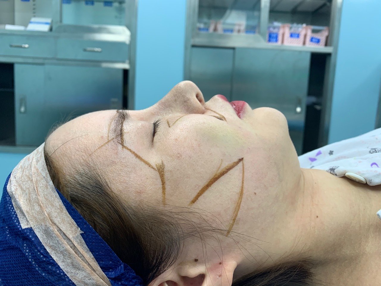 术前鼻子萎缩 漏鼻孔 鼻小柱突出 鼻翼圆后缩严重 _圈子-新氧美容整形