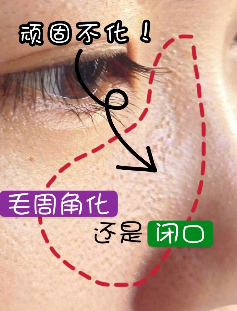 都2020年了,难道还有人分辨不出来闭口和毛周角化_圈子-新氧美容整形