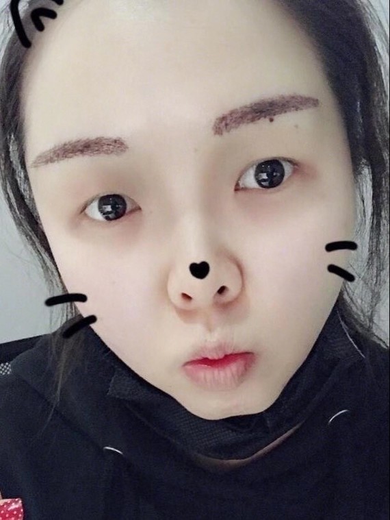 眉毛缺失,断眉的妹纸可以试试9878千万不要瞎去买生发_圈子-新氧