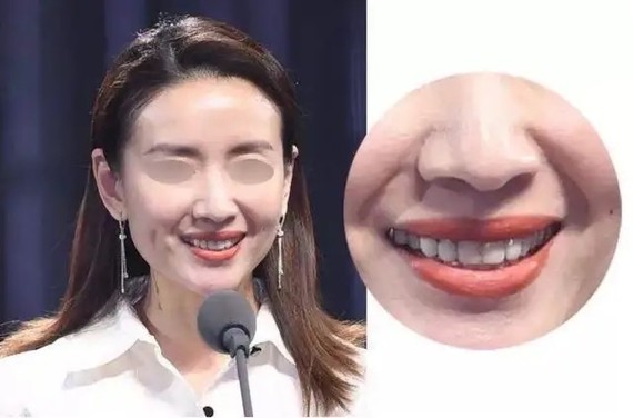 法令纹是老百姓的普通叫法,在医学上学名是"鼻唇沟",是位于鼻翼两侧与