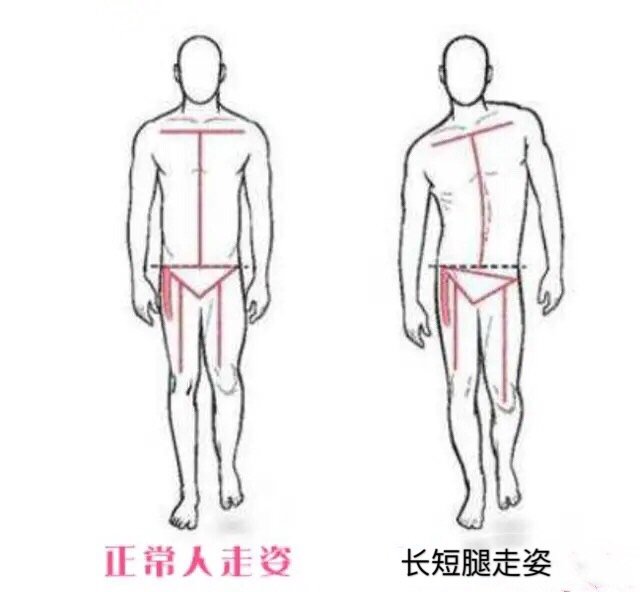 你走路姿势难看,可能是长短腿导致,该如何辨别与矫正_圈子-新氧美容