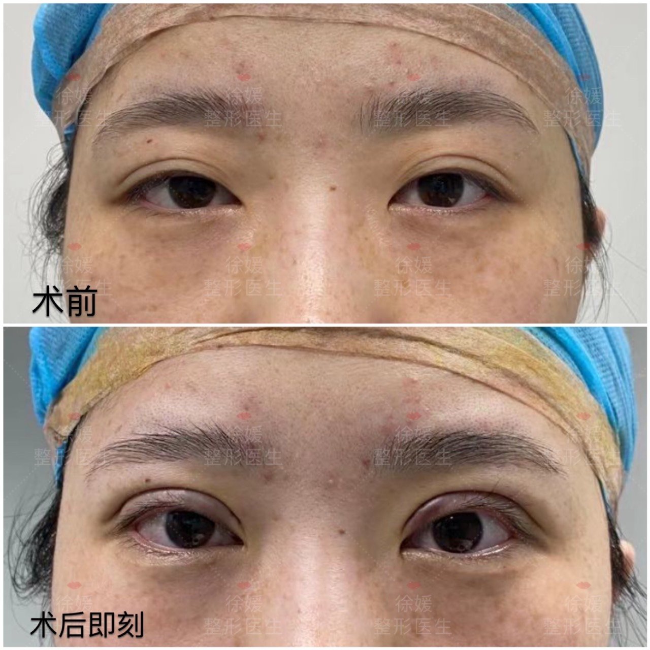 【全切双眼皮去皮去脂】术后即刻