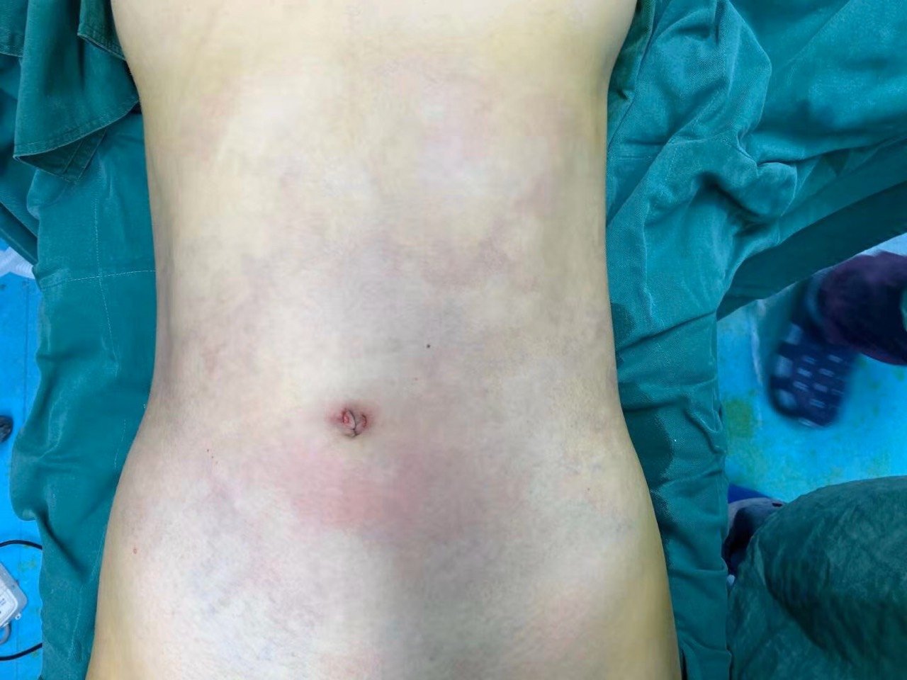 此图为刚抽完的状态 网上都说抽脂不疼,他们所指的不疼是全麻手术