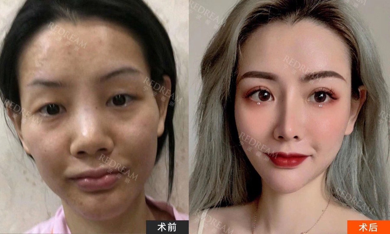 切眉or提眉哪个效果更好 俗话说 眉目传情 可 圈子 新氧美容整形