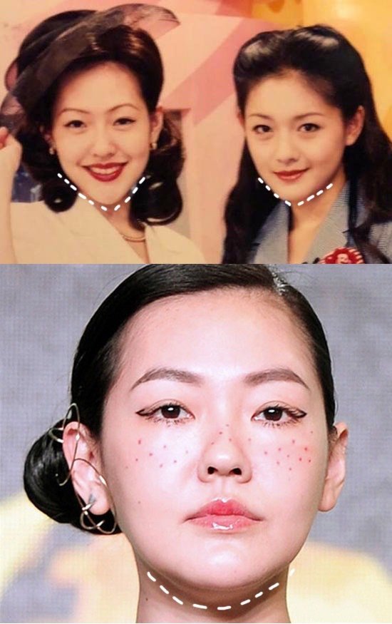 7315下颌骨宽度太窄,是造成双下巴的一个因素,这也是_圈子-新氧