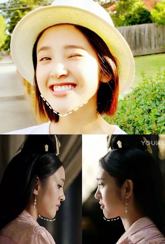 7315下颌骨宽度太窄,是造成双下巴的一个因素,这也是_圈子-新氧