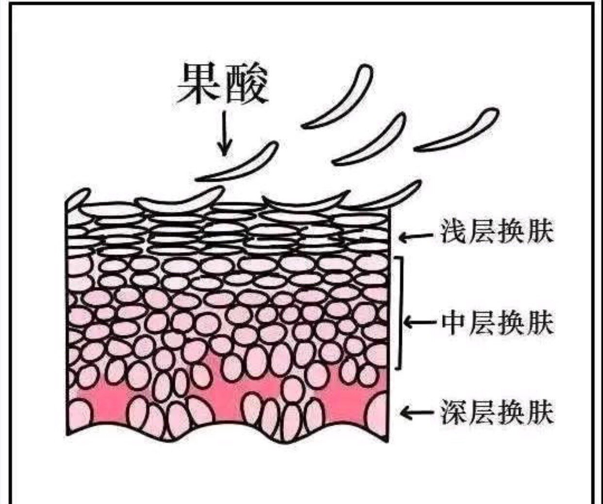 果酸换肤_圈子-新氧美容整形
