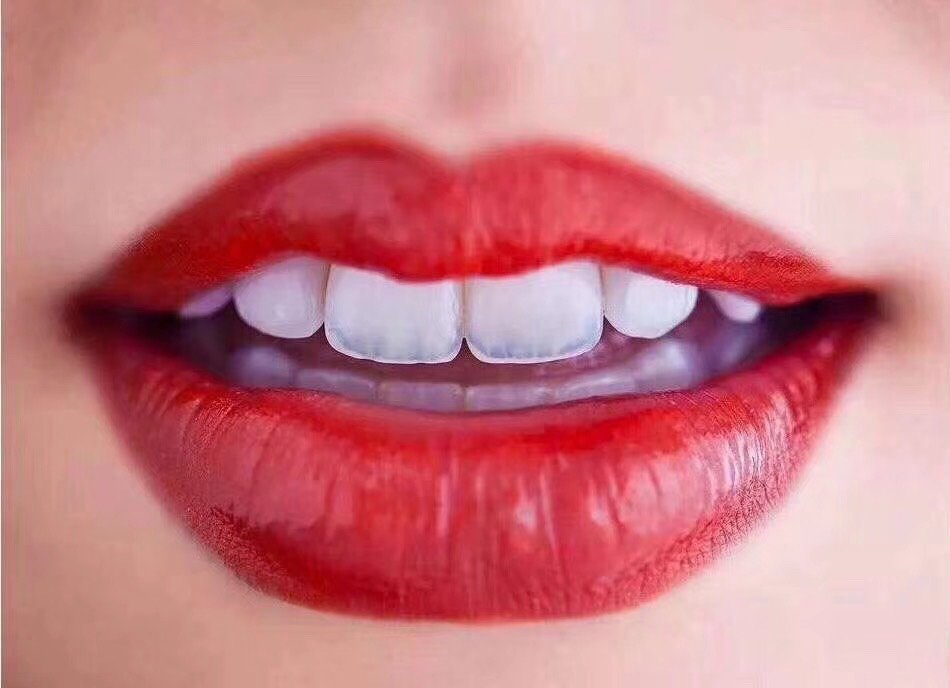 唇红齿白的诱惑,全瓷贴面,你,值得拥有