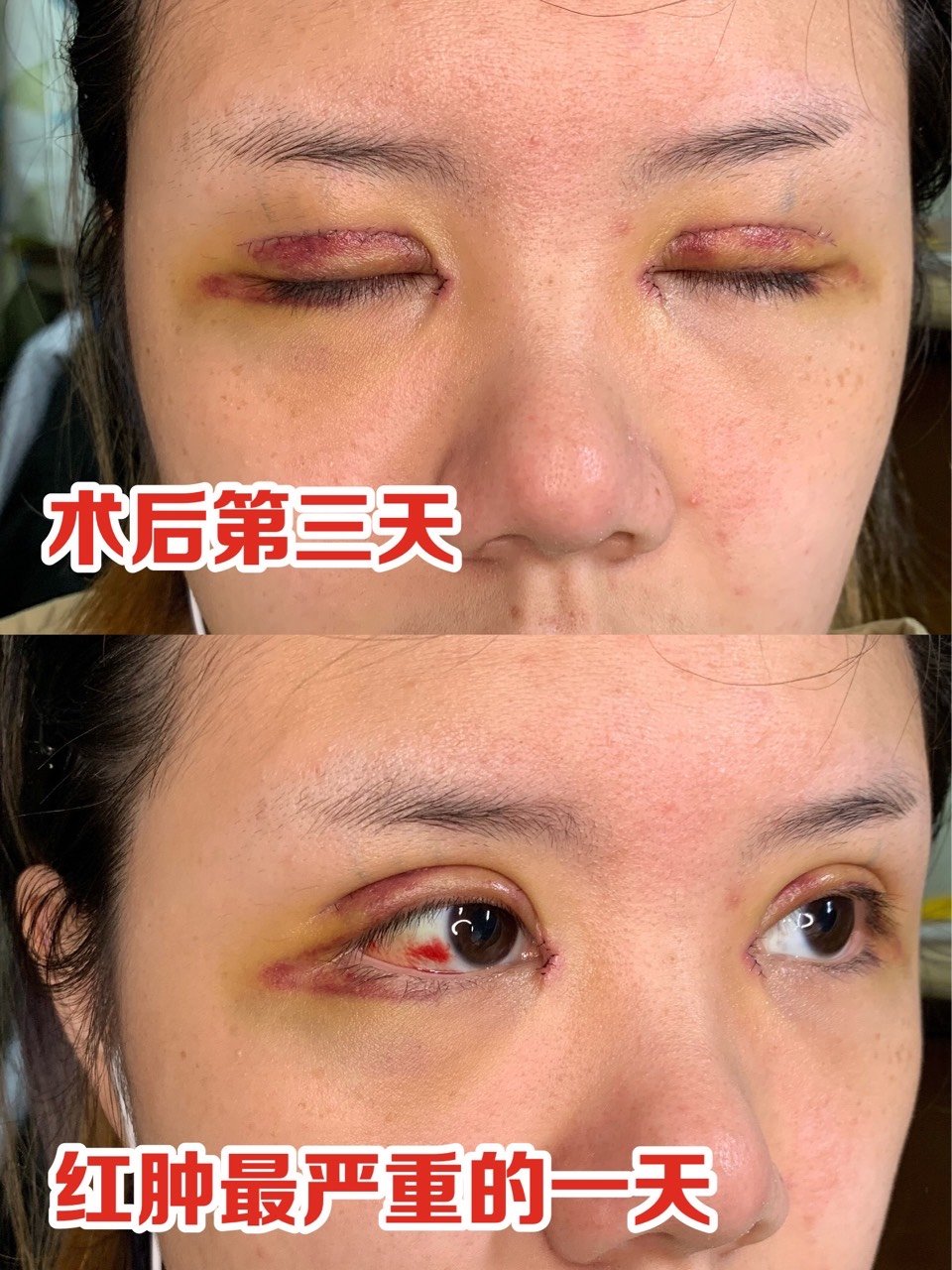 全切双眼皮开眼角肿眼泡矫正手术过程&术后护理