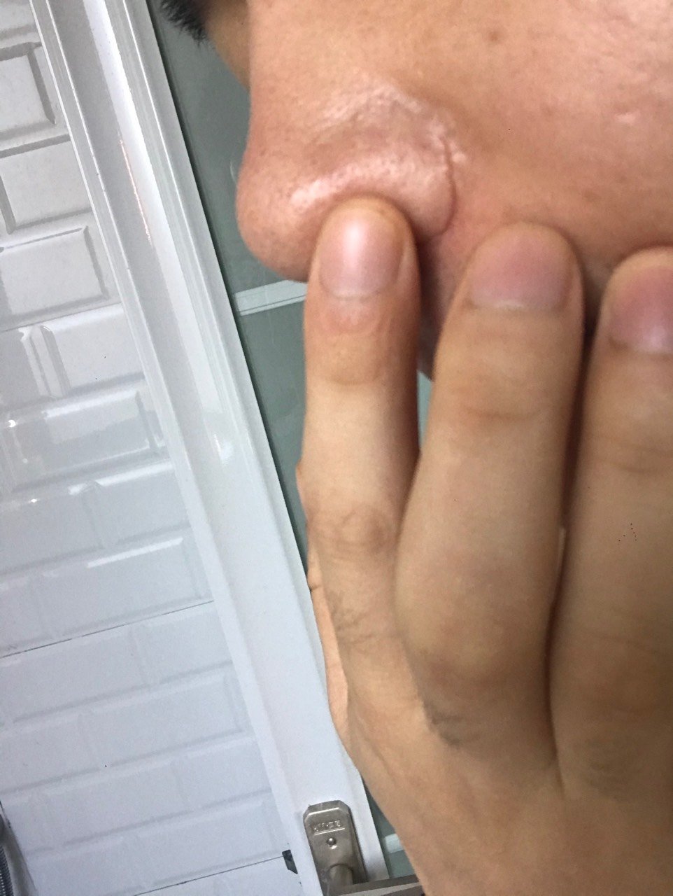 三年前做的外切鼻翼,术后左边伤口没愈合,当时去医院找医生,本来想