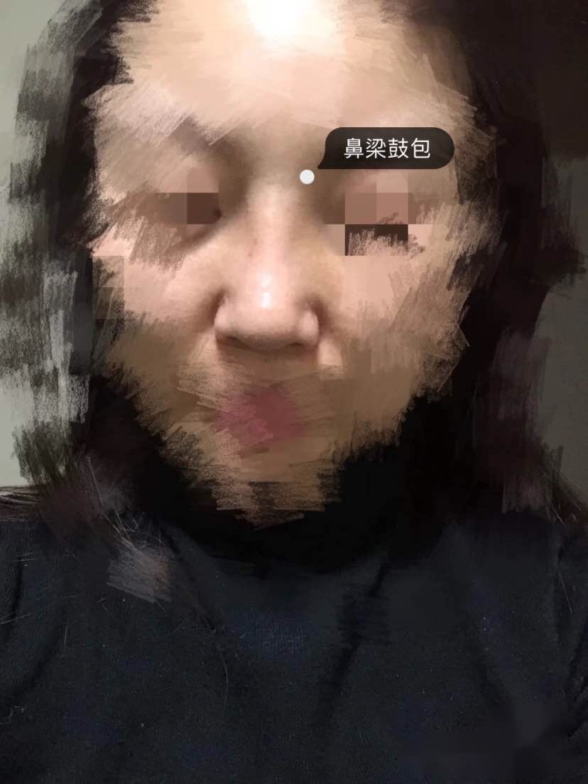 术后鼻子山根处(鼻梁)的小鼓包怎么办?