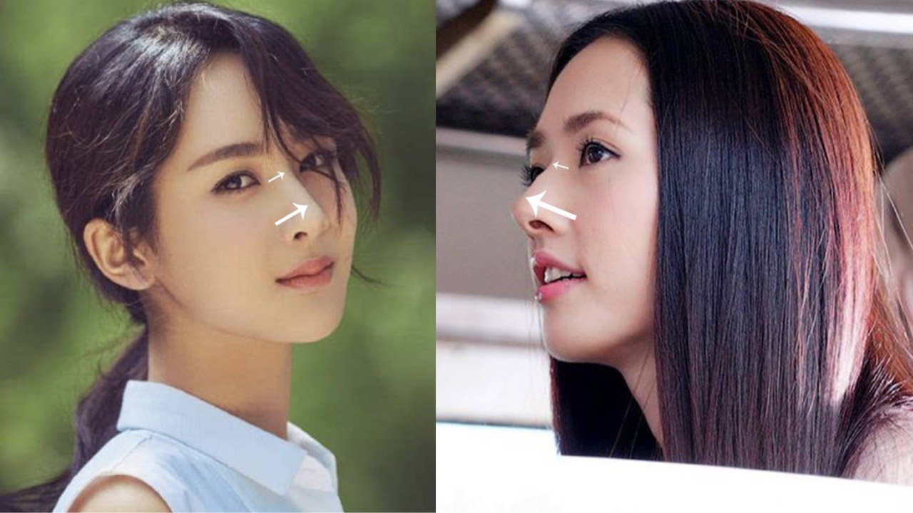 山根的高度如何影响鼻子和中庭的长度!