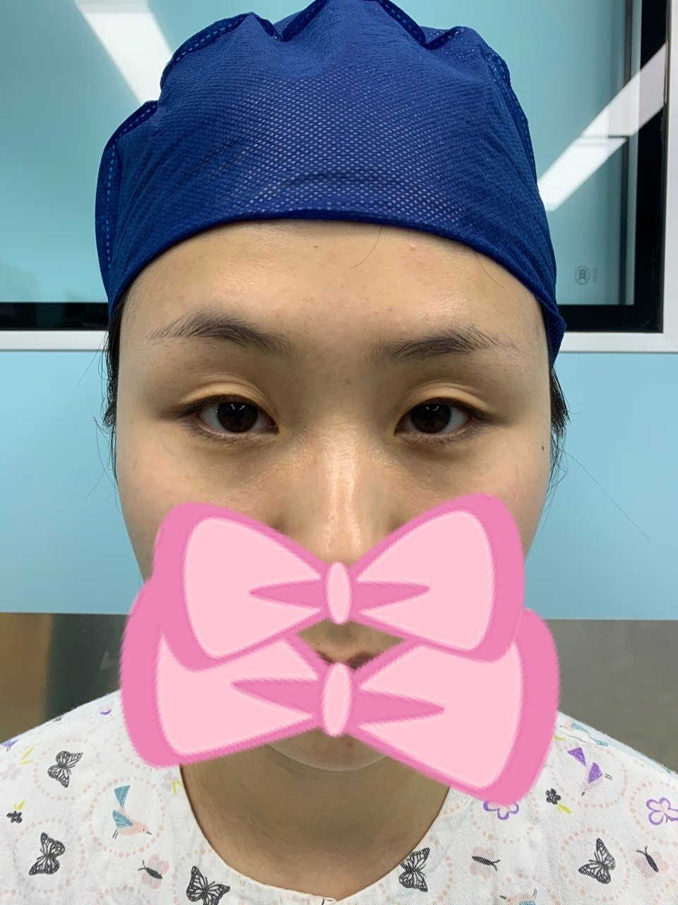 术前眼皮多重睑中度