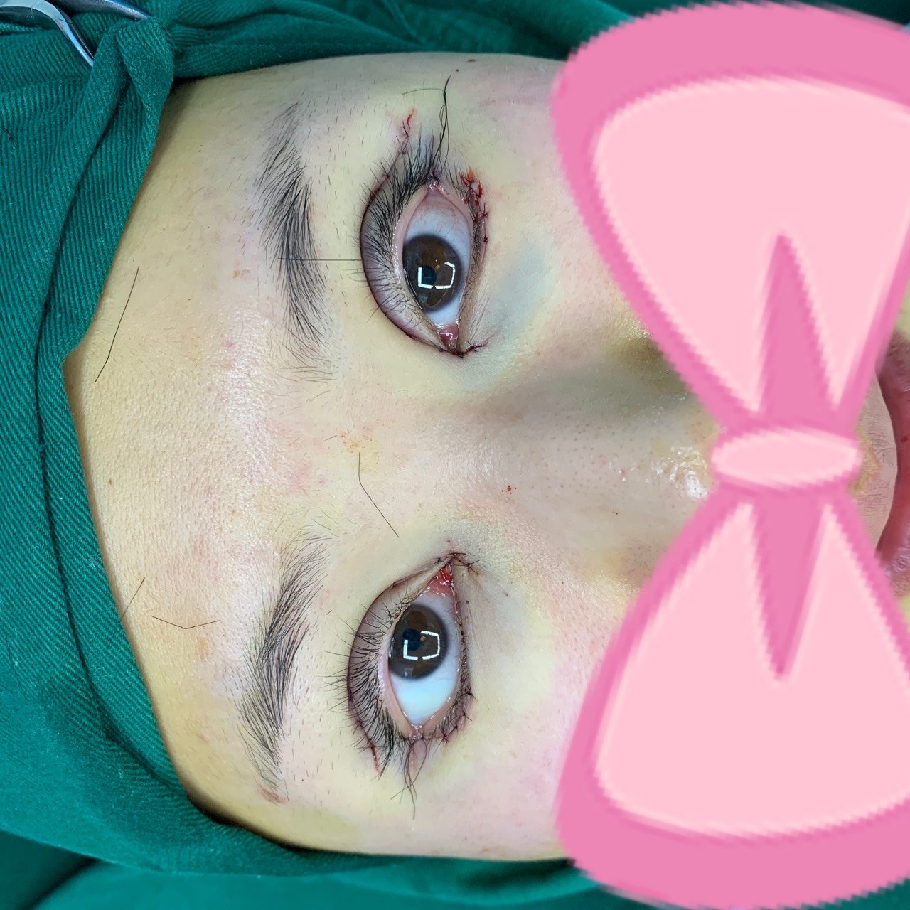 术前眼皮多重睑中度