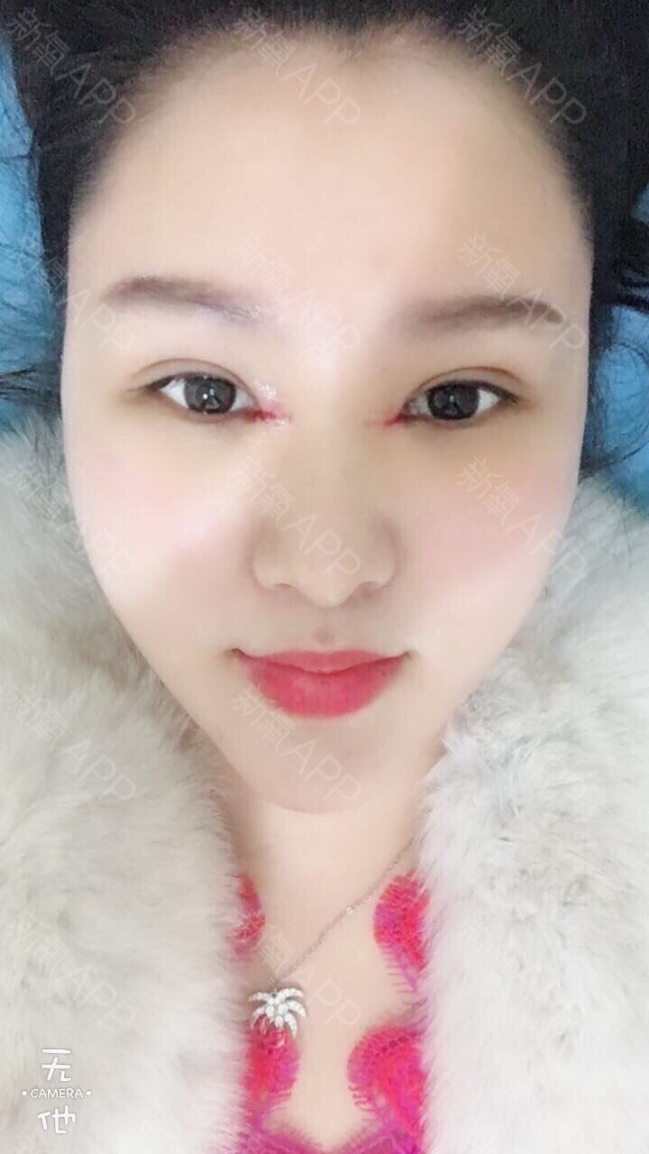 睐美安王振军做的内眼角修复五天啦,上面三张是今天的_圈子-新氧美容