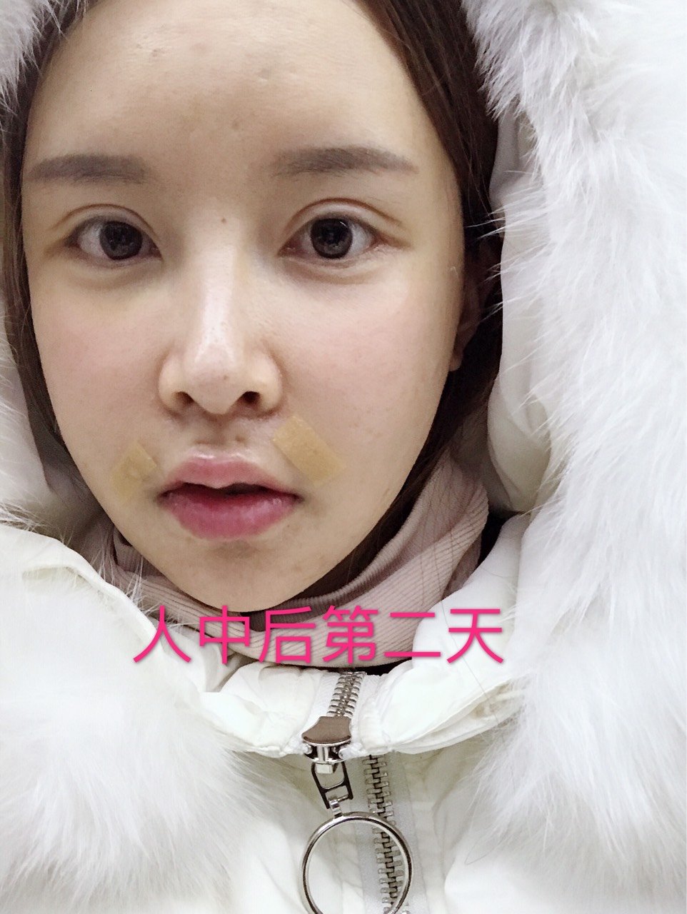 让人中缩短的几个方法,你get到了吗