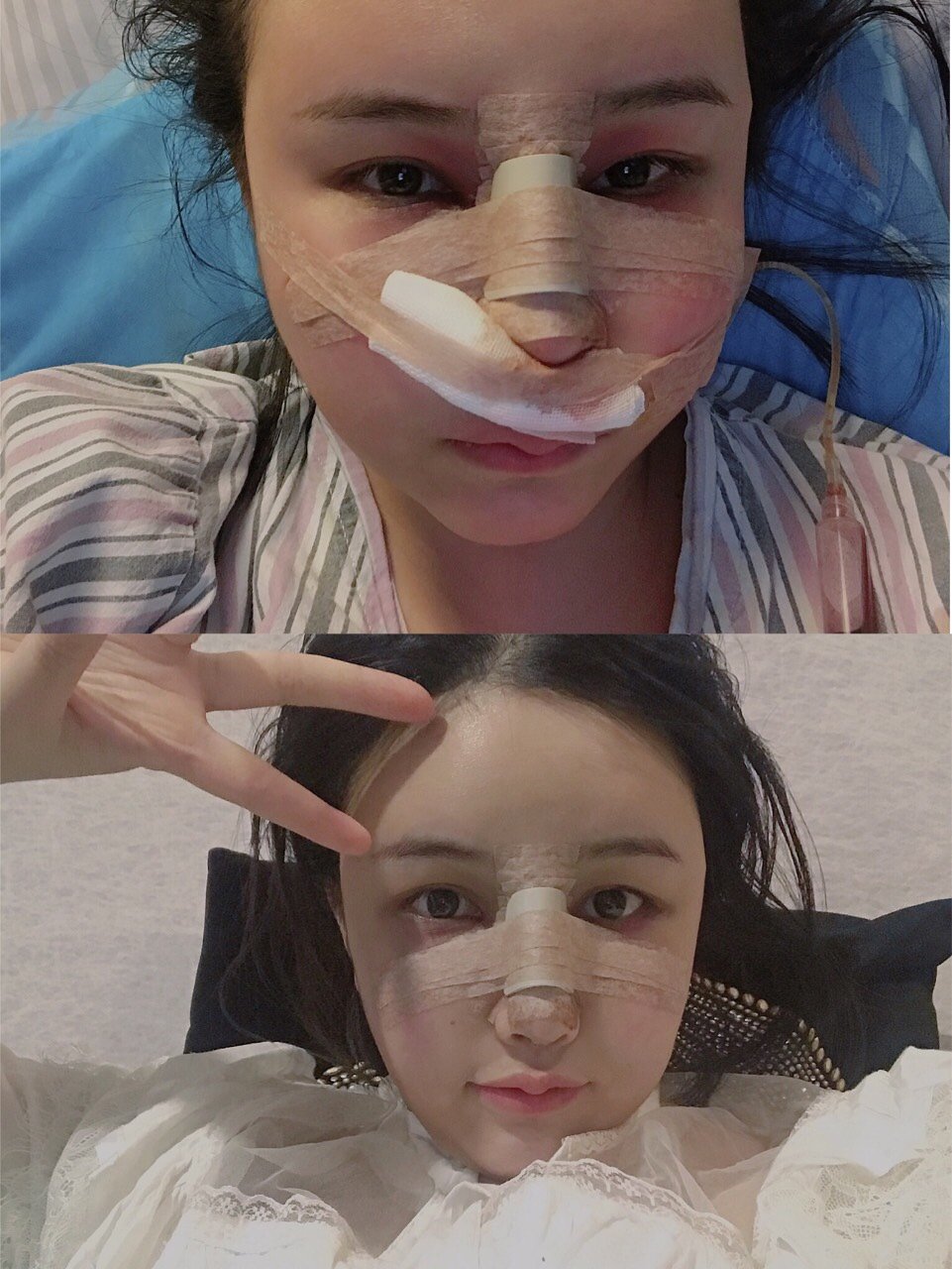 拿着最美网红夏夏的照片做鼻子,我get同款日系直鼻_圈子-新氧美容整形