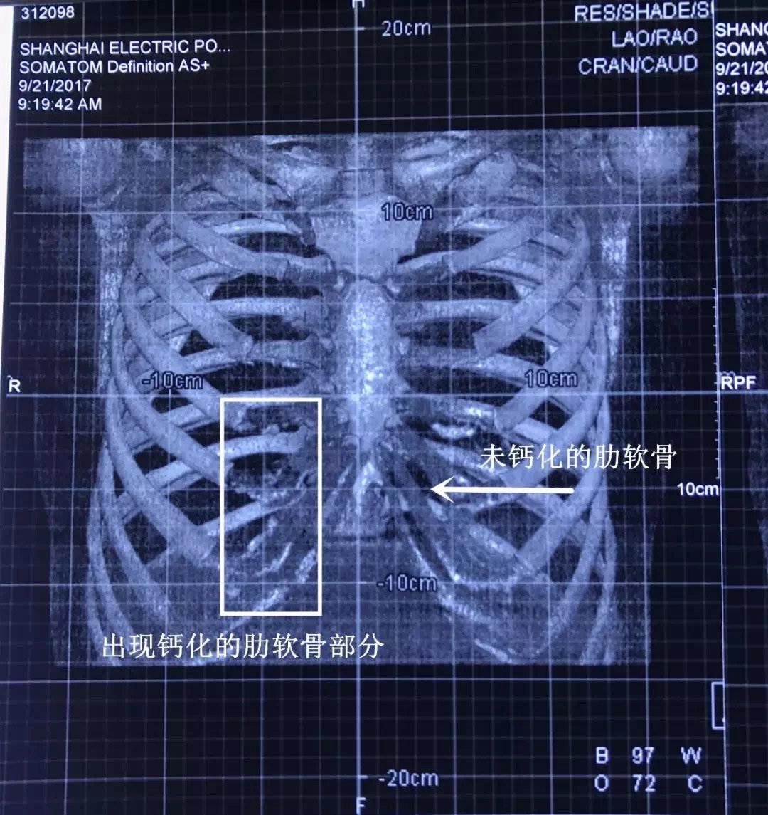 肋串珠图片