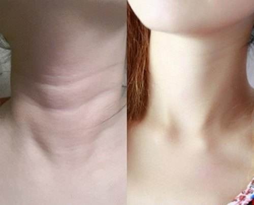 脖子的老化程度比脸快10倍以上,所产生的颈纹就和脖子转动及低头的