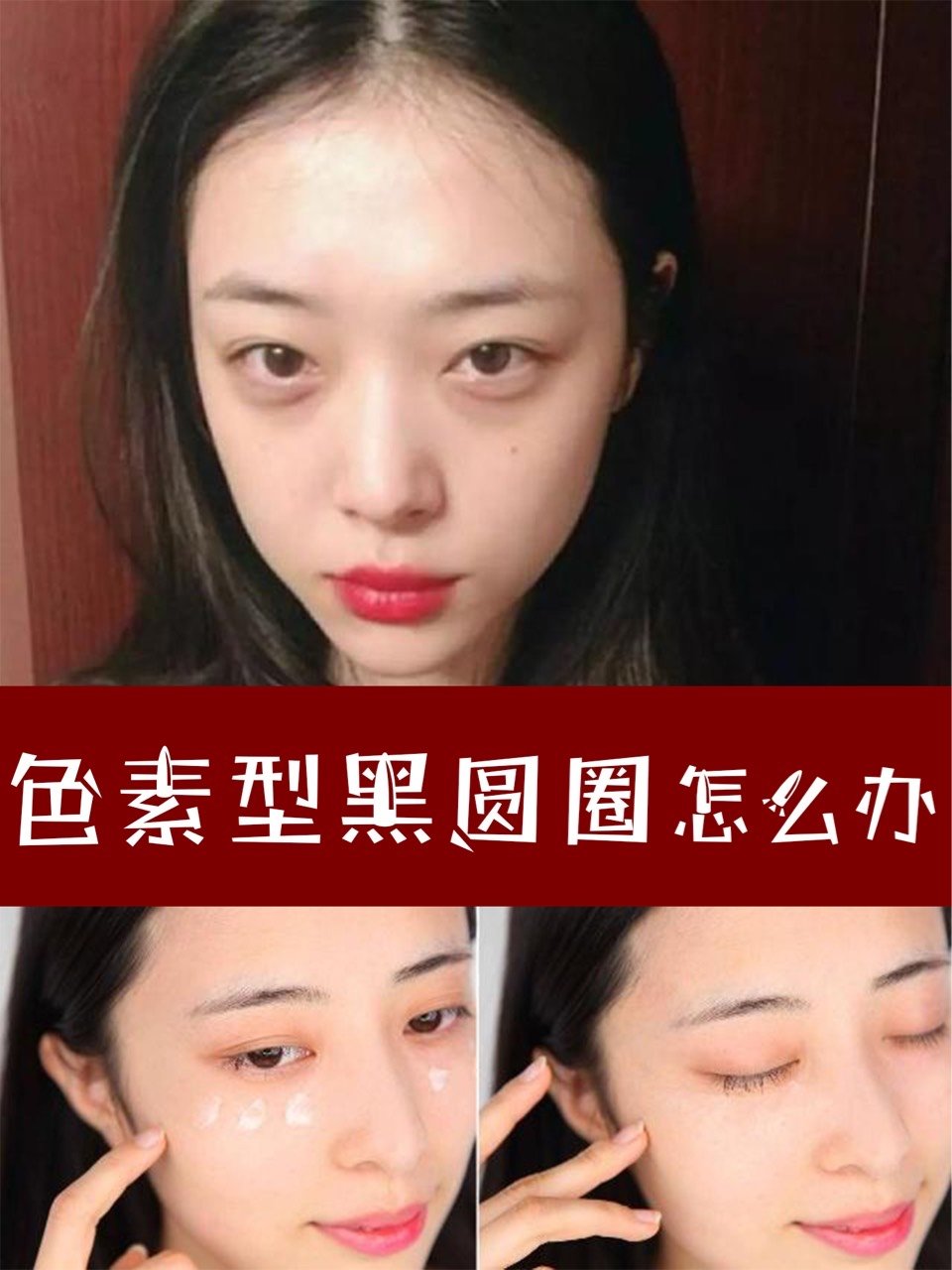 色素型黑眼圈怎么办?