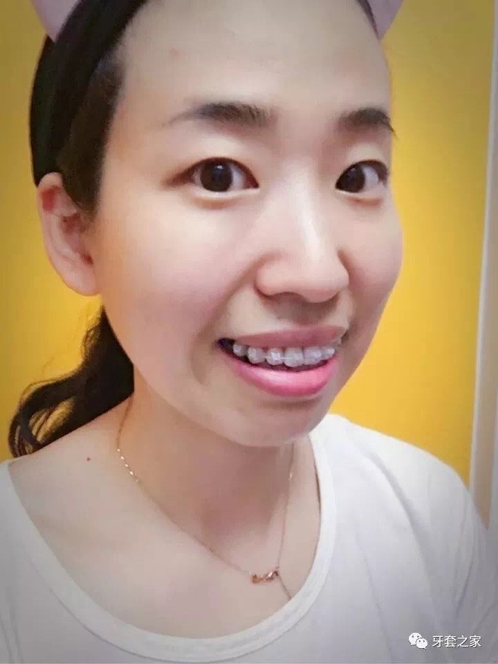 看到关于箍牙变美的帖子,就在想,那几颗坏牙干脆不要了,正好有点嘴凸