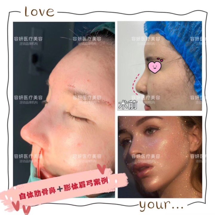 假体膨体眉弓