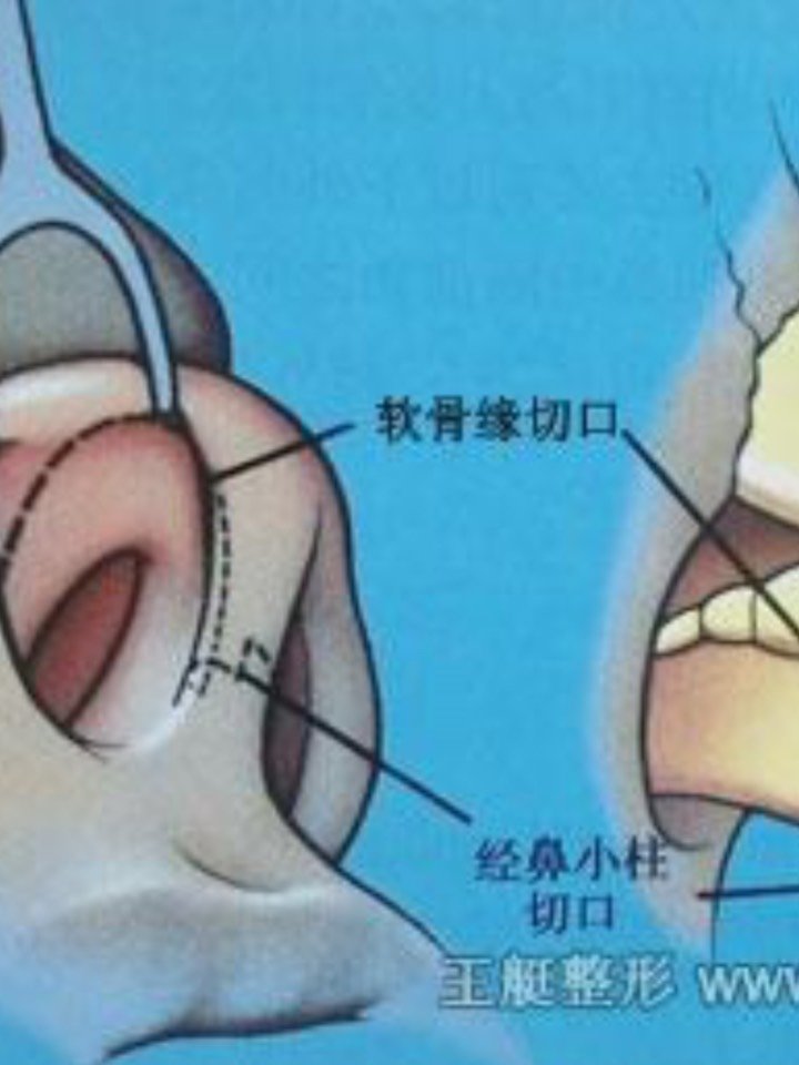 03浅谈鼻基底填充9799填充鼻基底的手术入路有两种,97_圈子