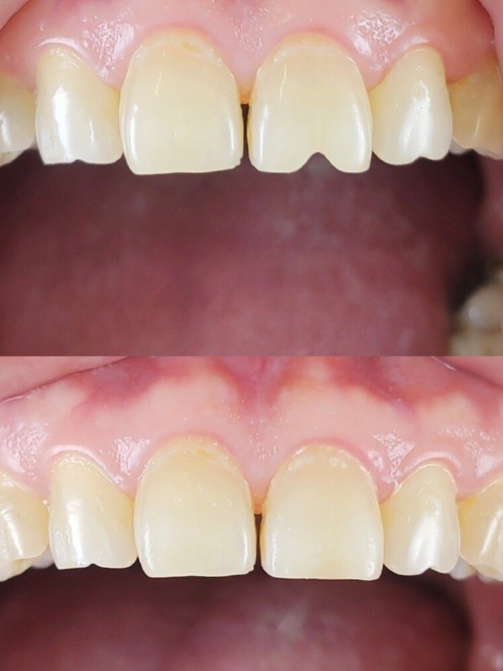 树脂补牙瓜子豁深圳世纪河山口腔真人案例