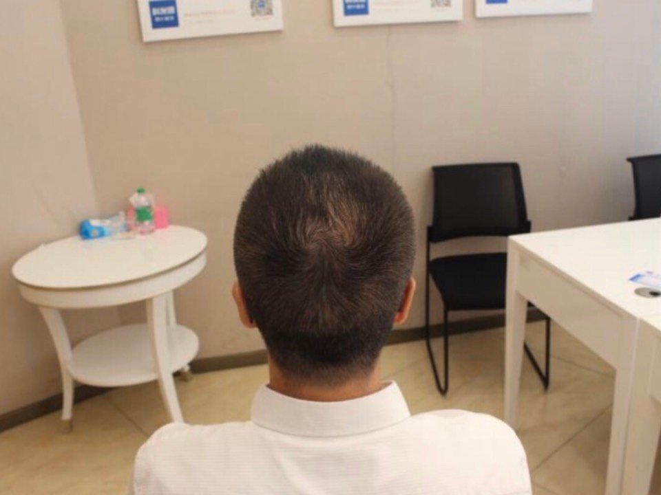 我做手术取了五千单位的毛囊,但是现在看后脑勺的头发根本看不出来我