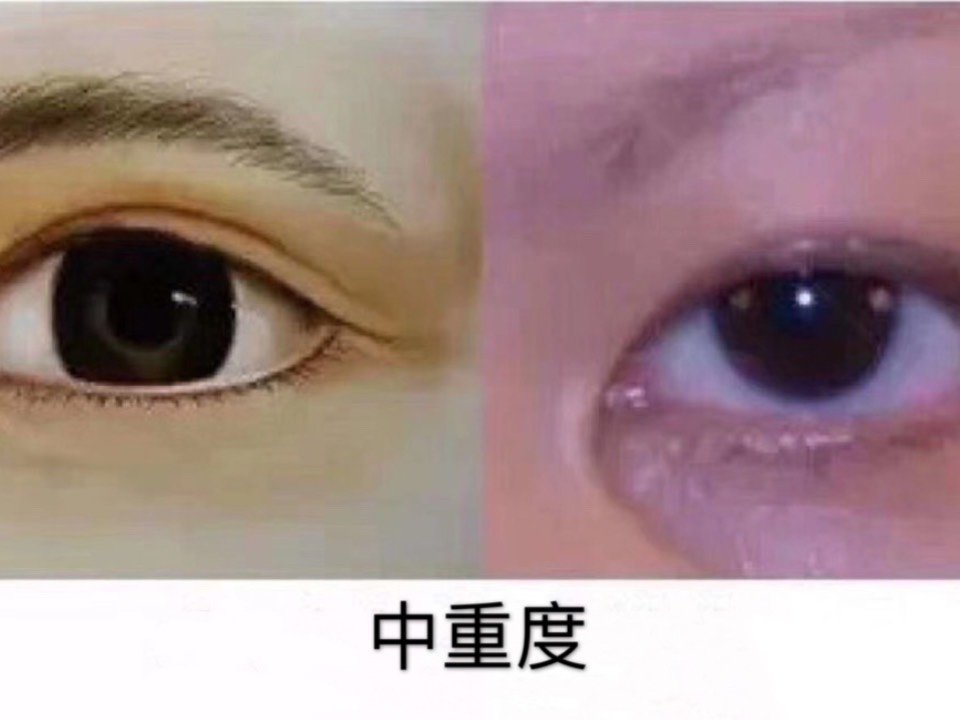 常见于中亚,北亚,东亚等地区的蒙古人种中,故又称"蒙古褶",是东方人