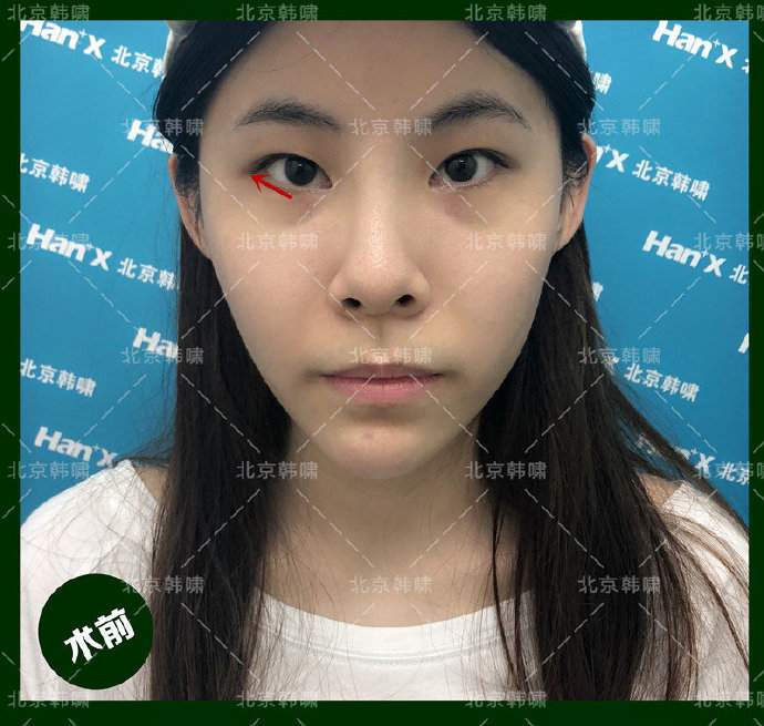 吊眼显凶,【下睑下至 外眼角】打造可爱萌眼[:95_圈子-新氧美容整形