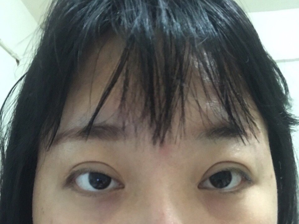 在他们家做的双眼皮 上睑肌无力提升,做了两次了,就这德行,然后不闻不