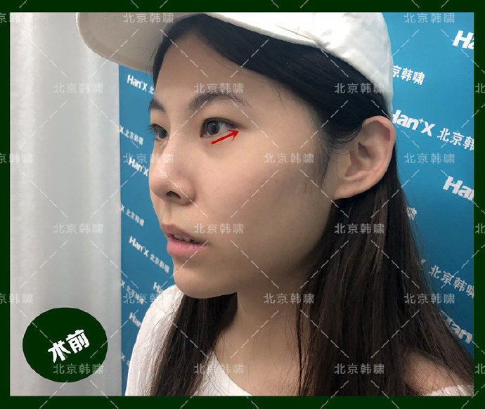 吊眼显凶,【下睑下至 外眼角】打造可爱萌眼[:95_圈子-新氧美容整形
