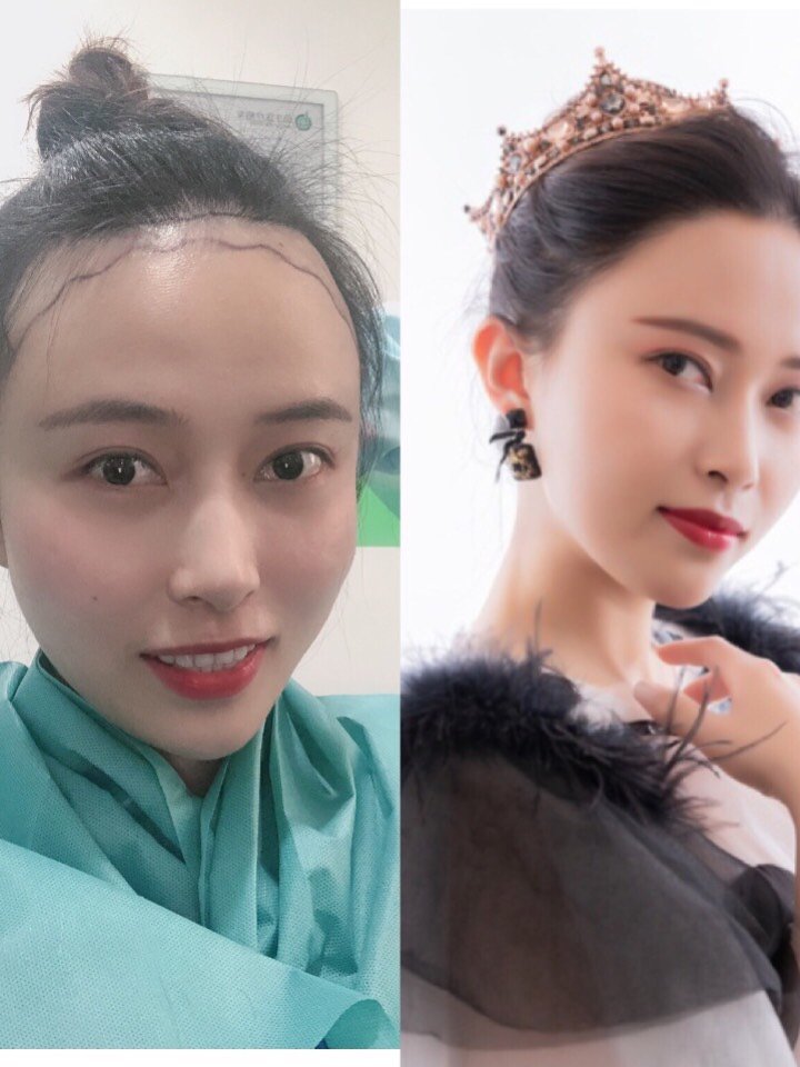 成功的发际线植发术后一年分享