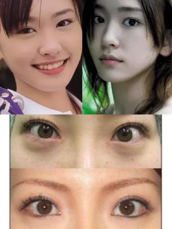 吊梢眼,外眼角上扬或者眼睑偏高,而眼睑下至能有效的改善,使得眼型