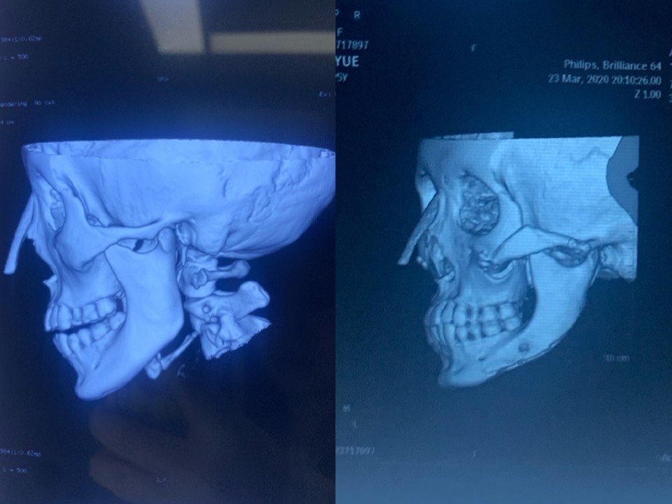 分享一下自己的ct图 做了颧骨颧弓 下颌角长曲线还