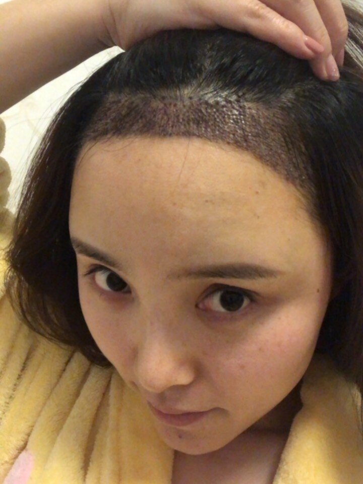 植发体验!拒绝贝勒头