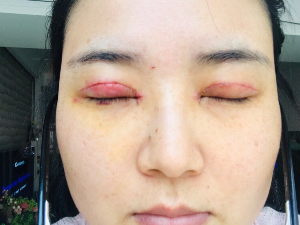 3月28第七天拆线日,拆线好疼,直流眼泪,眼睛有点_圈子-新氧美容整形