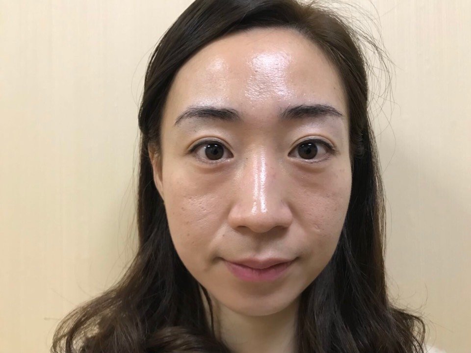 术前眼袋挺大的,显老不说眼睛还时不时的会酸痛,估计_圈子-新氧美容整