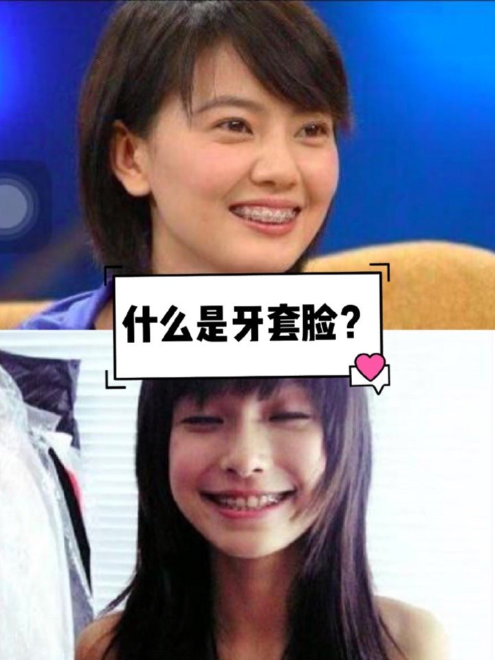 咀嚼肌萎缩 戴过牙套的宝宝会知道,刚戴上会有一段时间牙齿超级