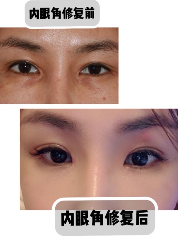 内眼角修复三个多月啦,恢复的基本差不多了