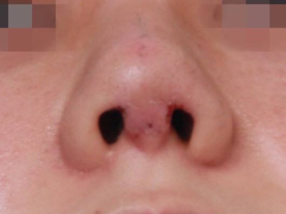 【韩国艾恩整形外科】隆鼻后疤痕增生会自愈吗?
