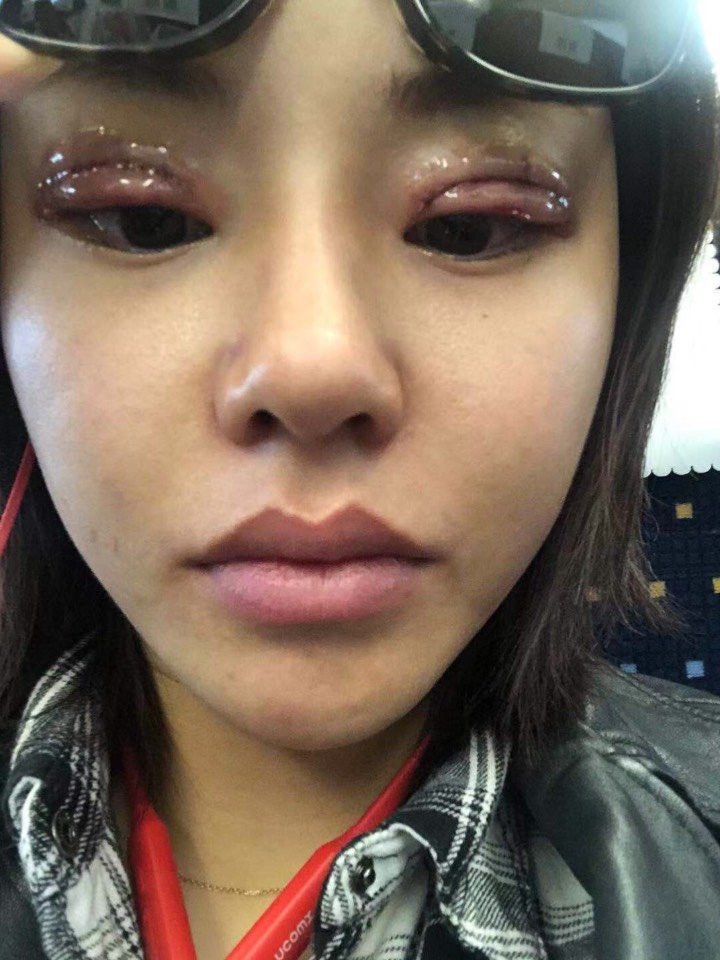 北京双眼皮修复手术,太血腥,慎点