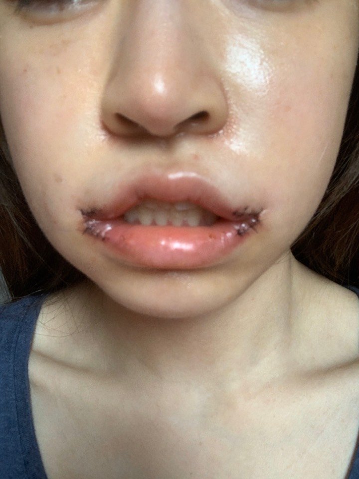 第二天肿成猪头了 不仅嘴肿的很大 下半张脸也肿