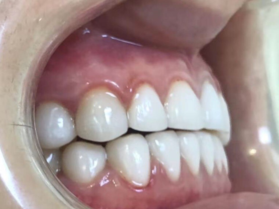 磨完牙齿大概半个月左右,通知过去做牙贴,中间也丑了_圈子-新氧美容